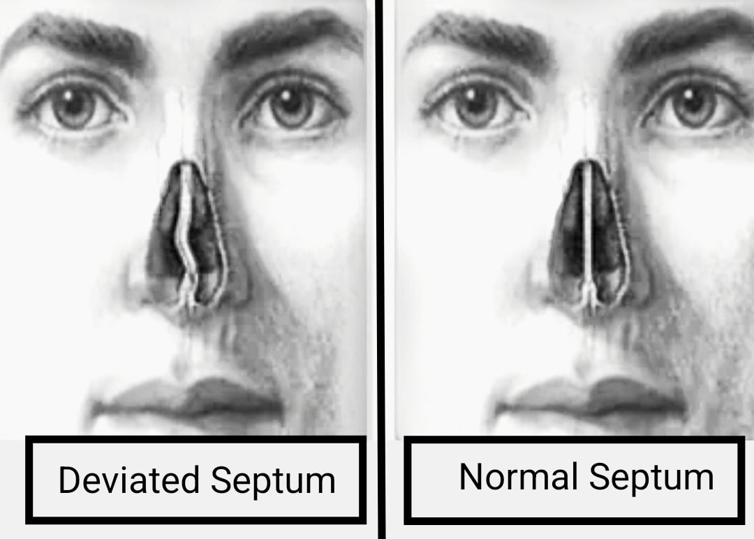 Types of Snoring Cause and Diagnosis